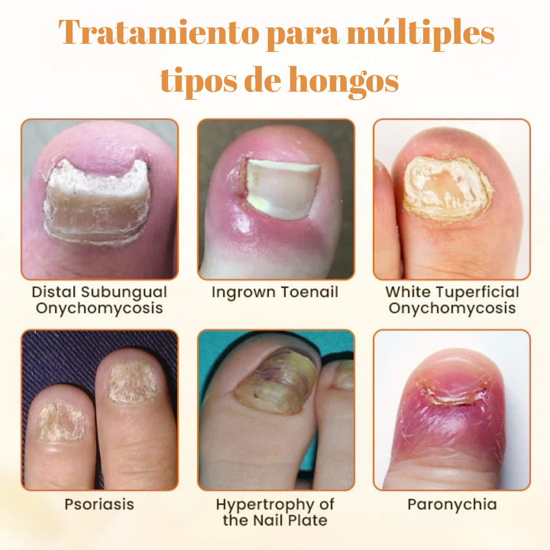 Removedor Hongos y reparador Avanzado de Uñas