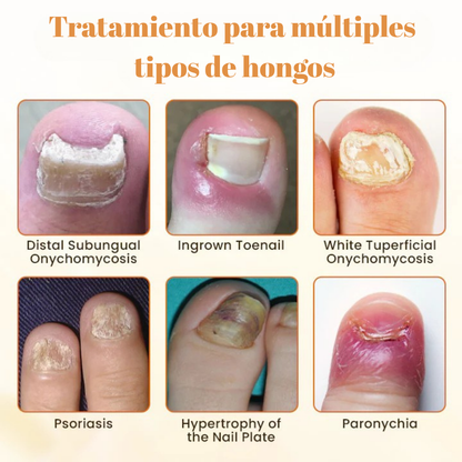 Removedor Hongos y reparador Avanzado de Uñas