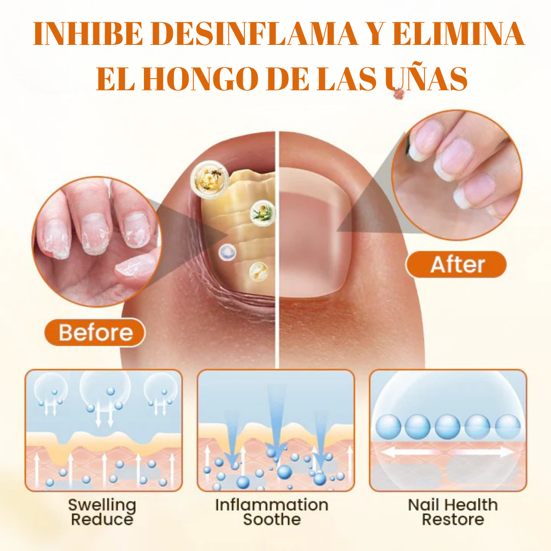 Removedor Hongos y reparador Avanzado de Uñas