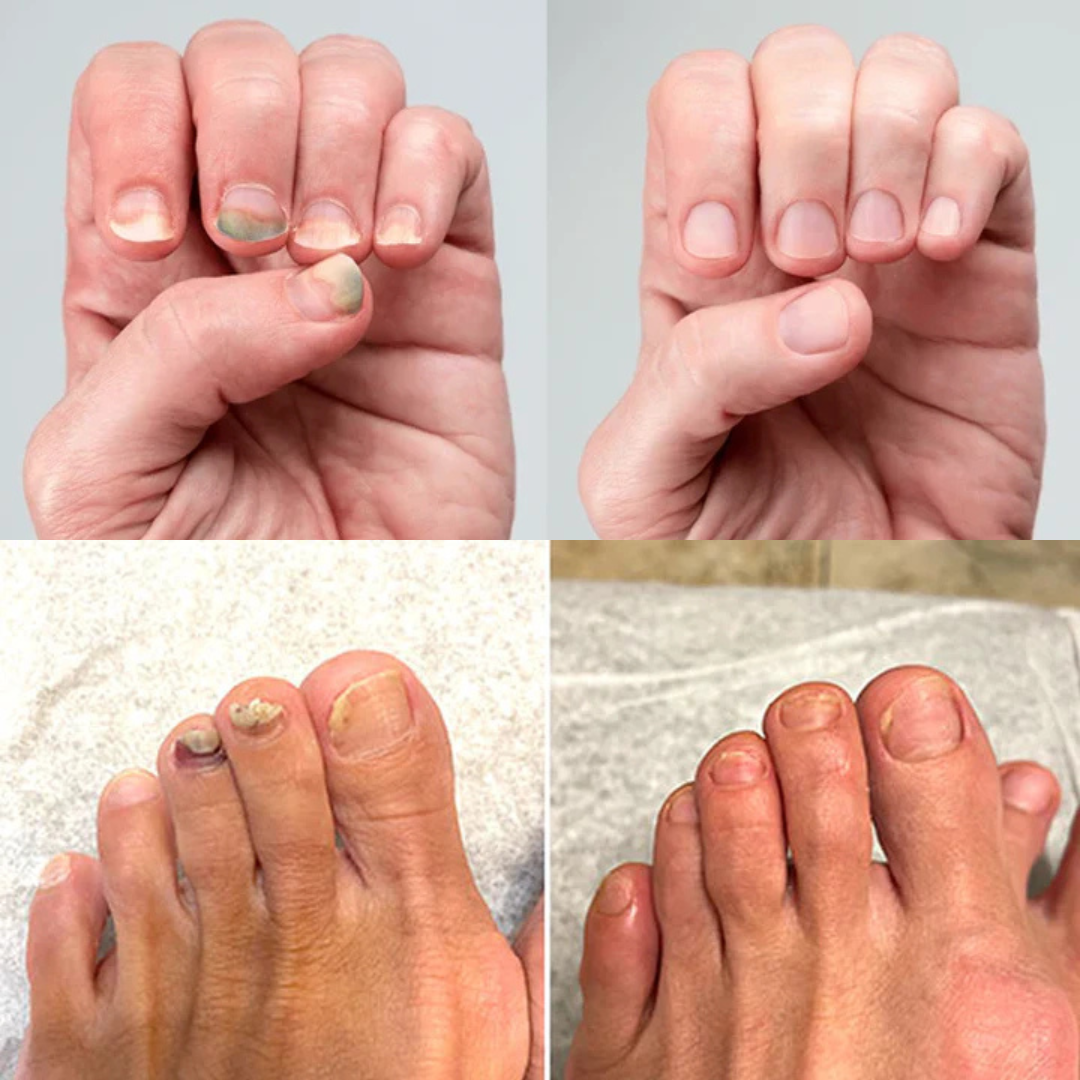 Removedor Hongos y reparador Avanzado de Uñas